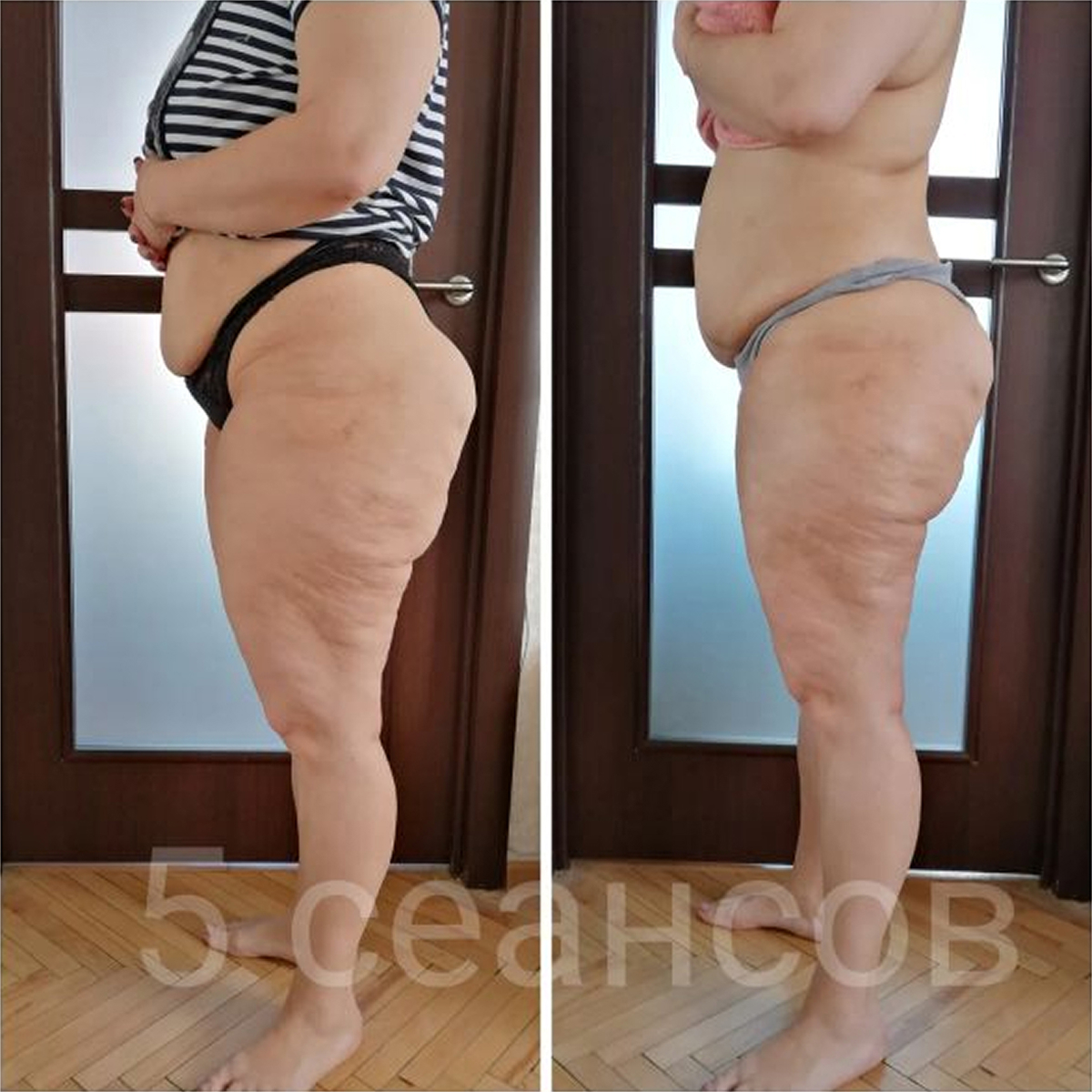 Результат: лимфодренажный массаж (до/после)