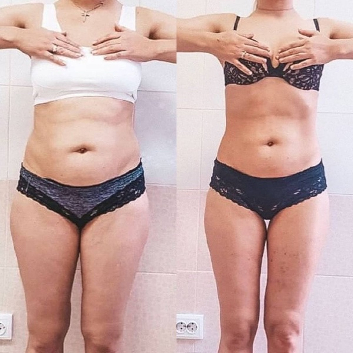 Результат: лимфодренажный массаж (до/после)